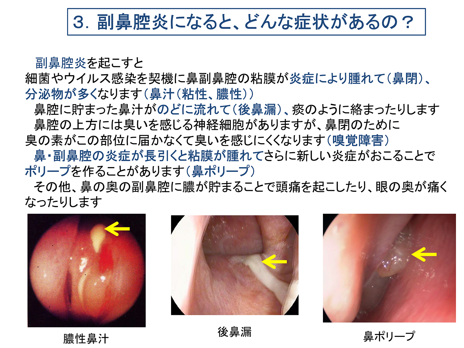 副 鼻腔 炎