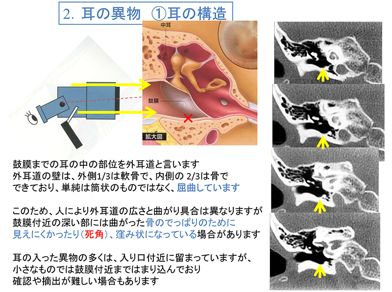 耳 に 異物