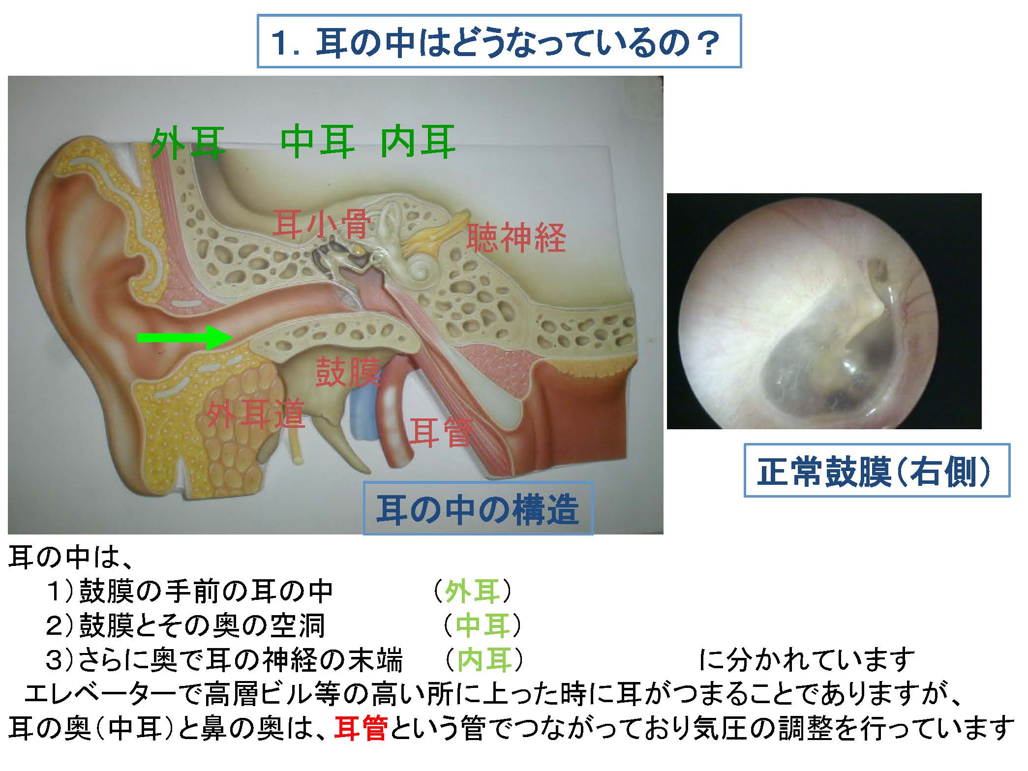 慢性、化脓性中耳炎、鼓膜大穿孔一年自愈经历 - 知乎