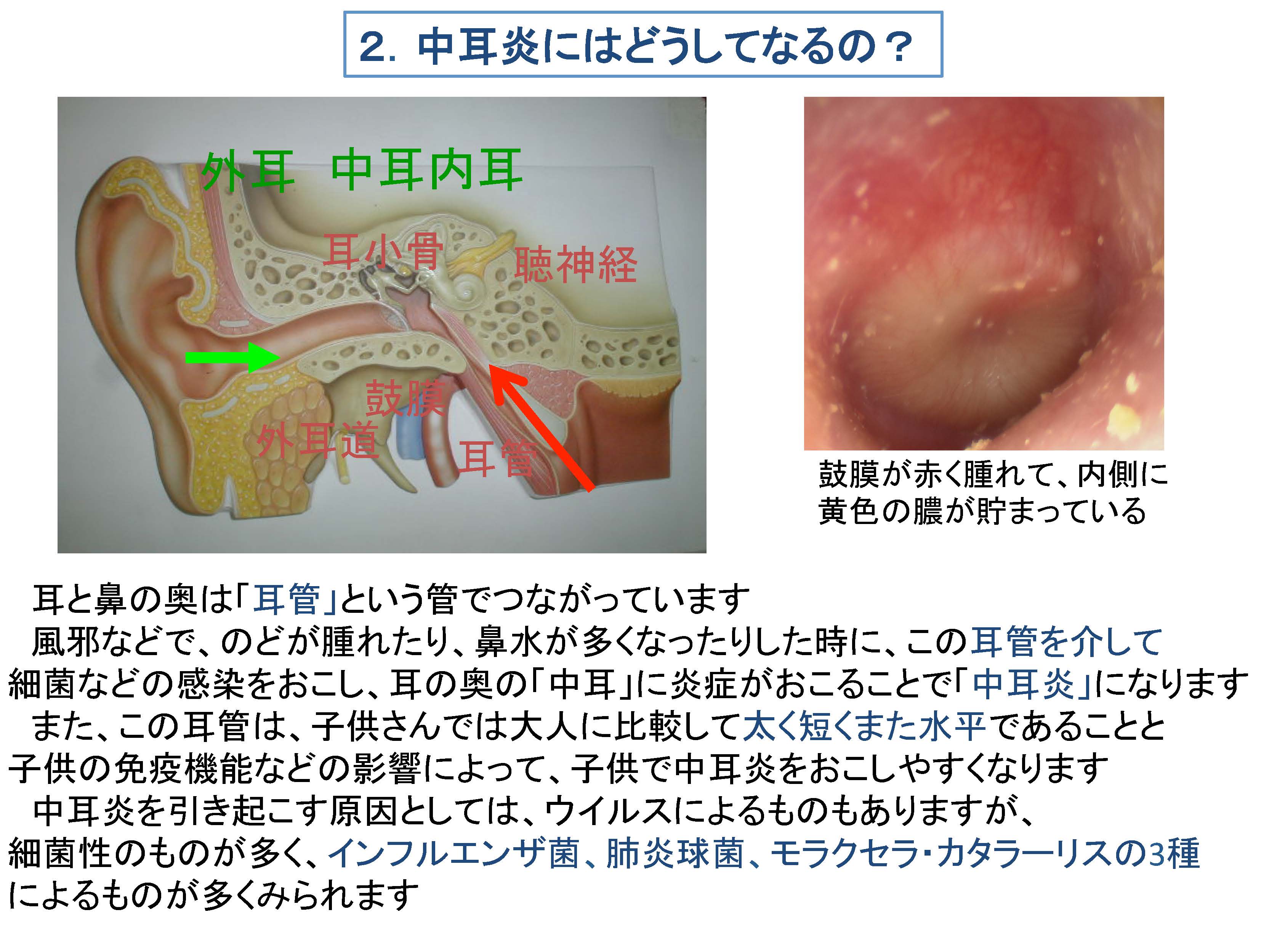 中耳炎 ほっとく と