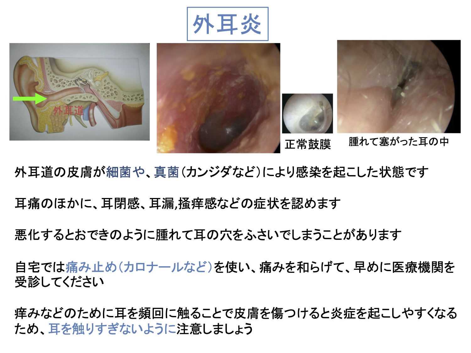 外耳炎
