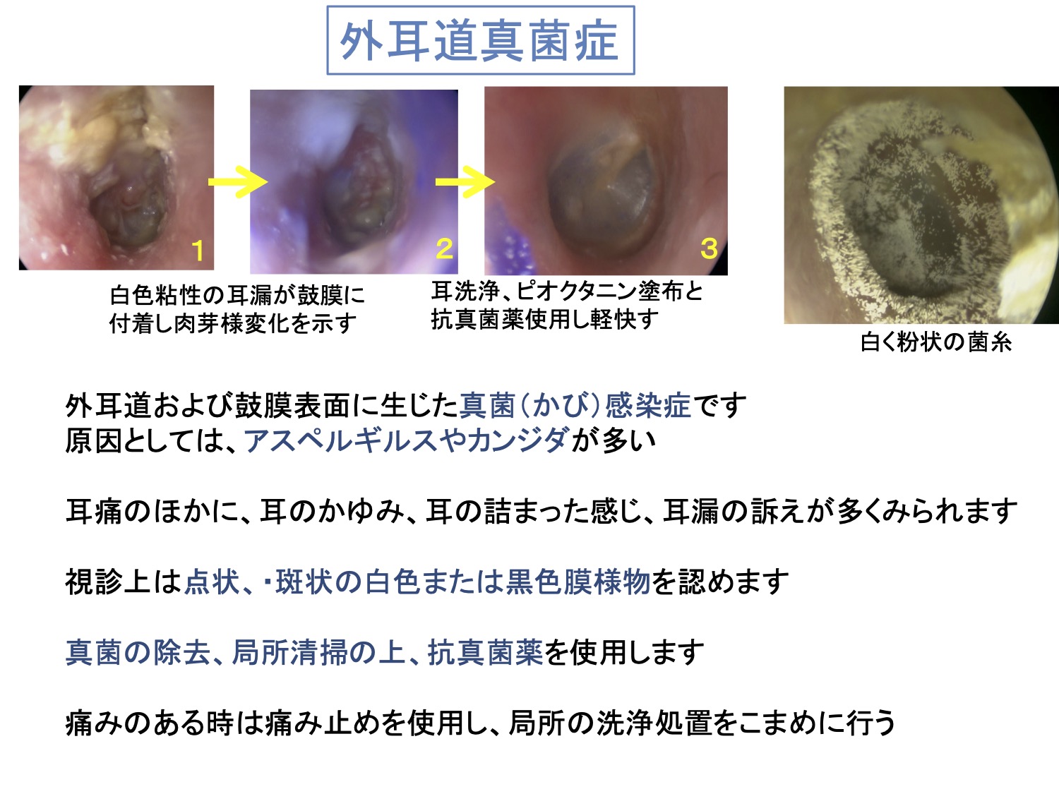 外耳道真菌症