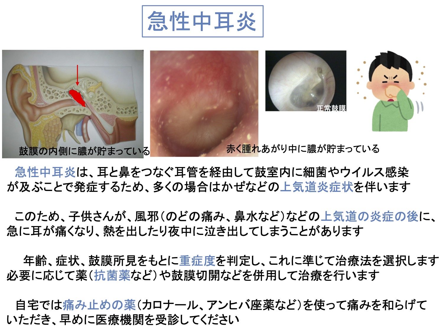 急性中耳炎