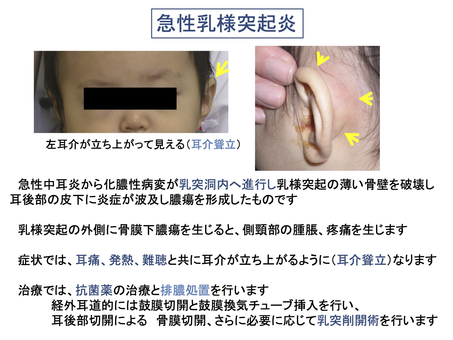 急性乳様突起炎