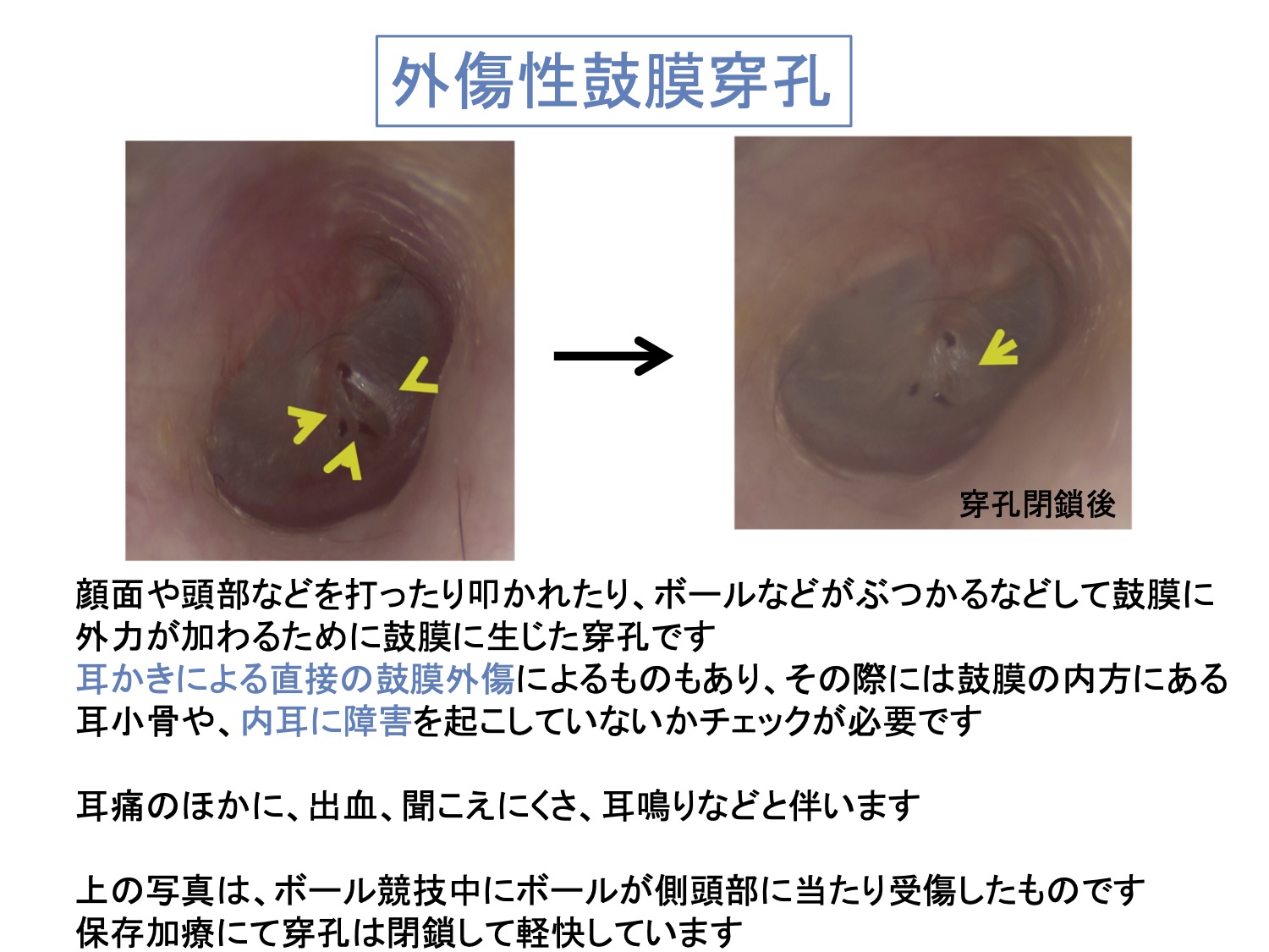 外傷性鼓膜穿孔
