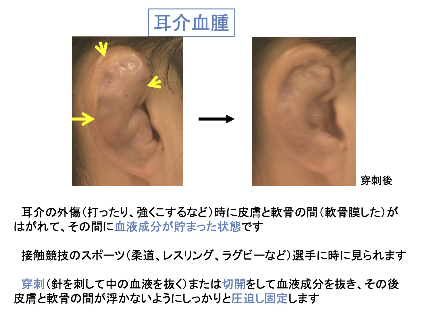 耳介血腫