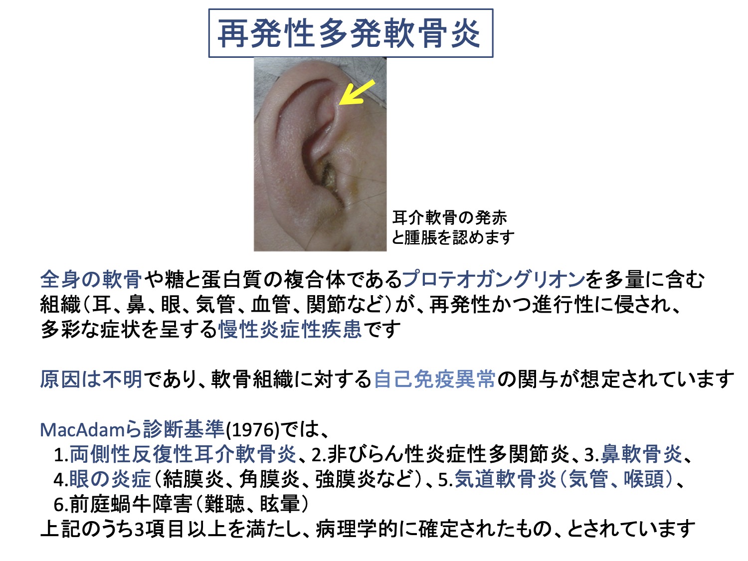 再発性多発軟骨炎