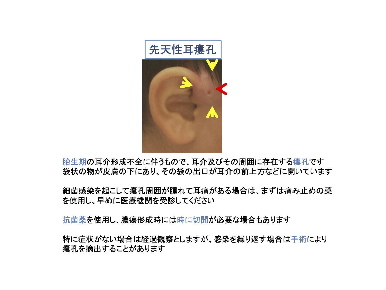 先天性耳瘻孔