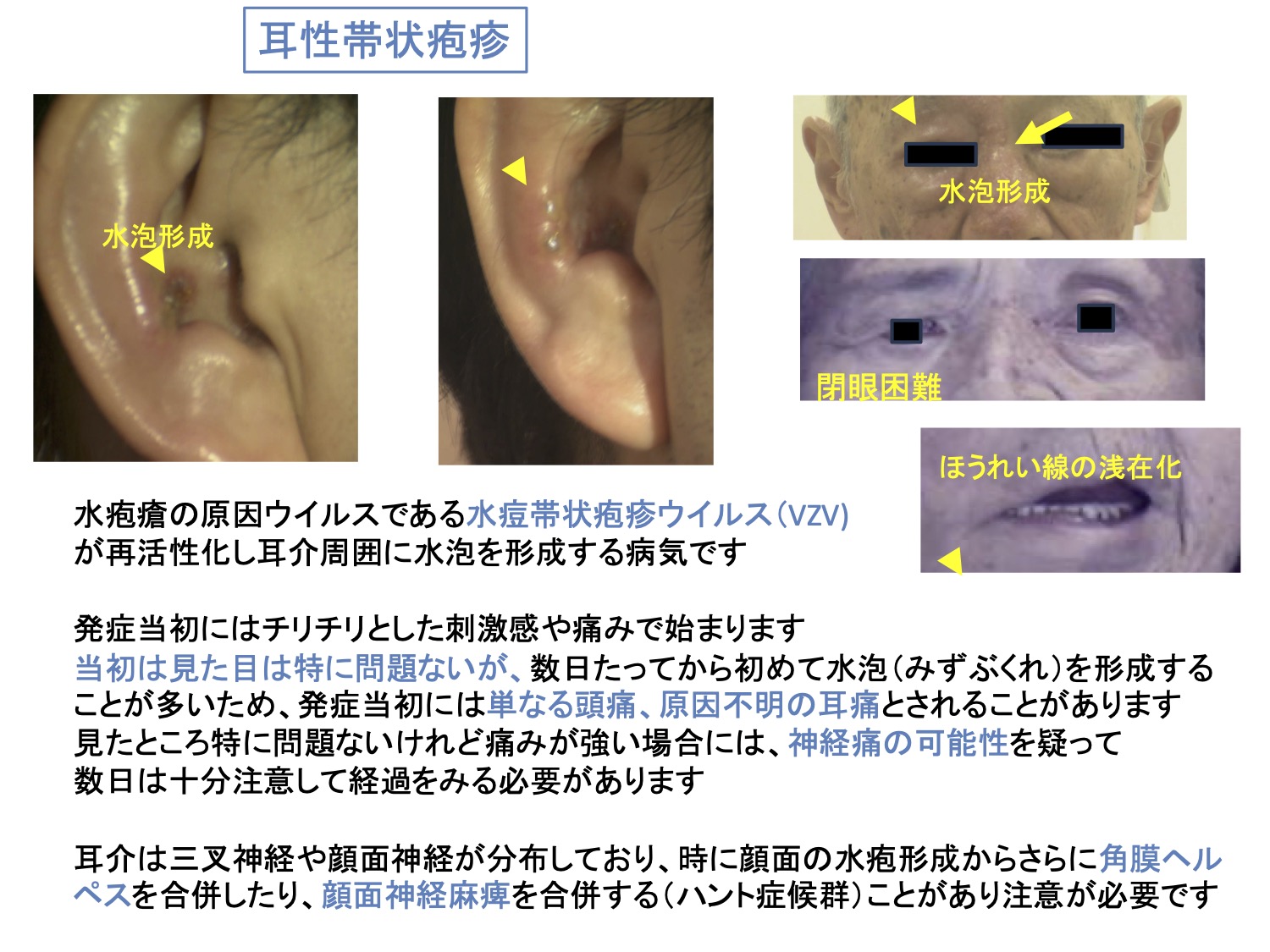 耳性帯状疱疹