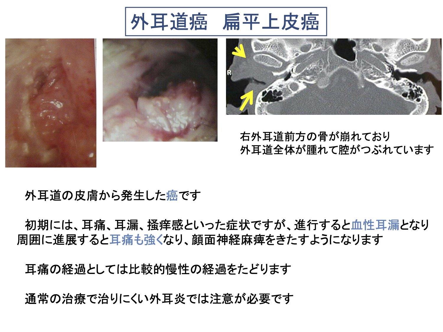 外耳道癌 扁平上皮癌