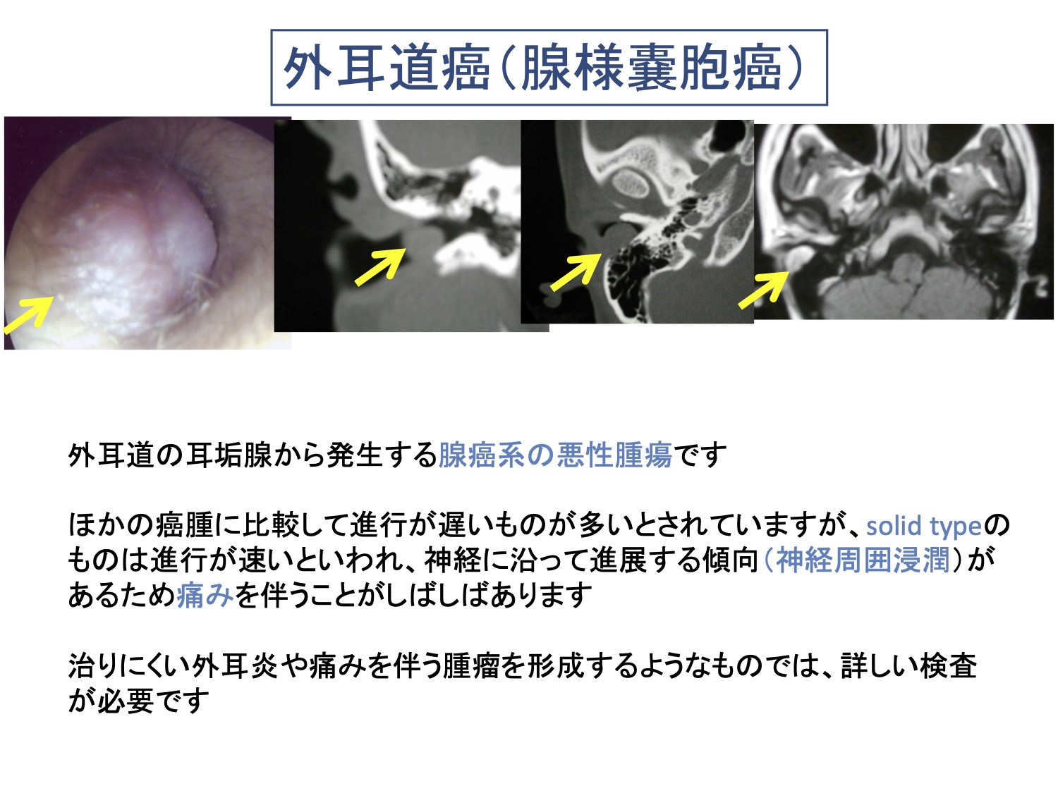 外耳道癌（腺様嚢胞癌）