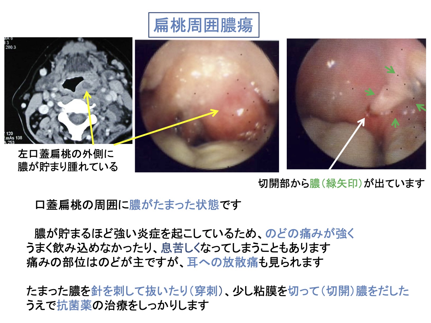 扁桃周囲膿瘍