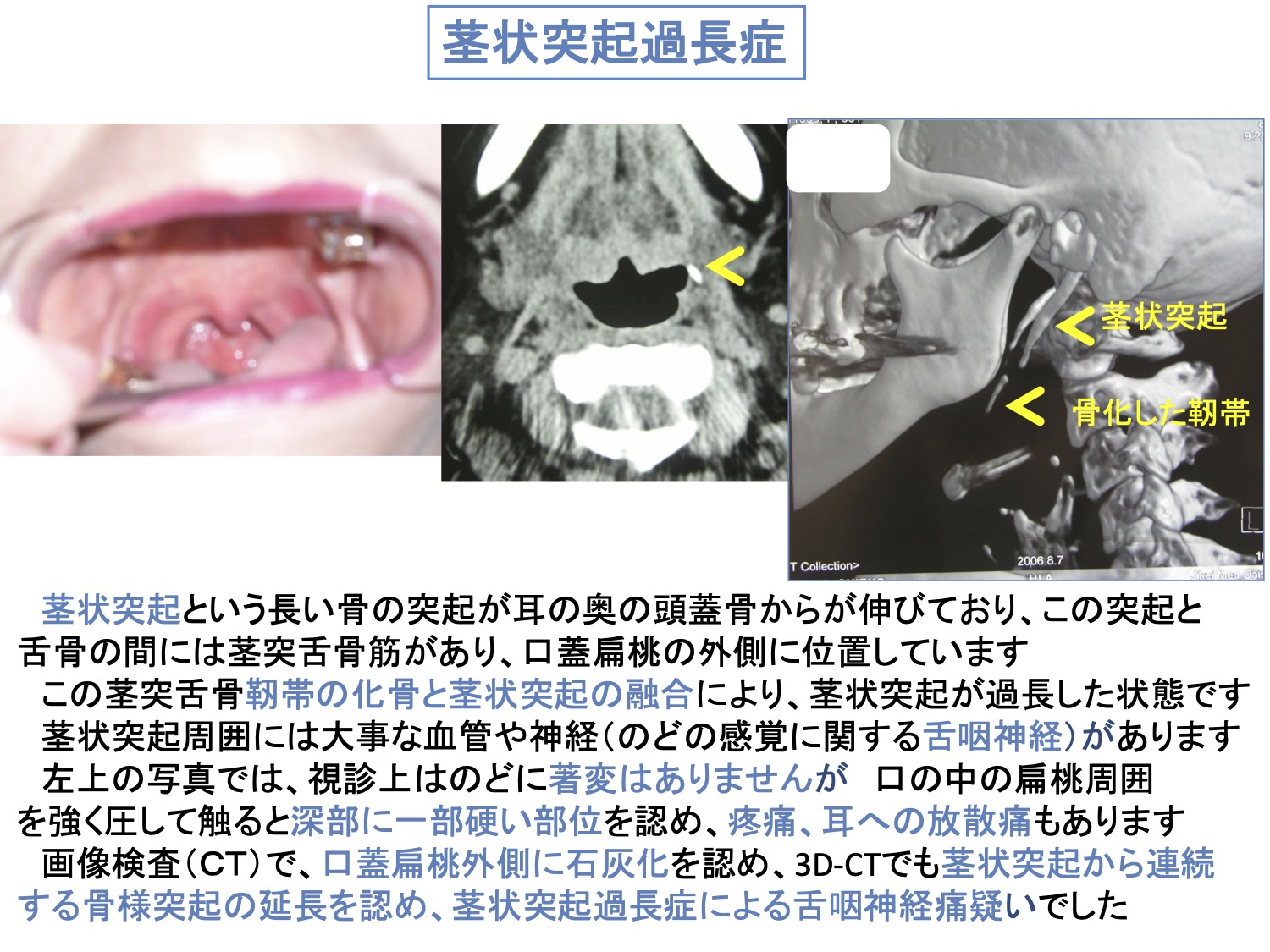 茎状突起過長症