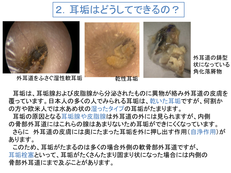 耳垢 栓塞 自分 で 治す