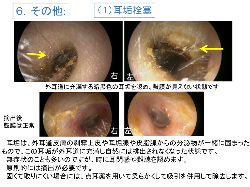 栓塞 耳垢 耳垢栓塞とは？症状・原因・治療・病院の診療科目