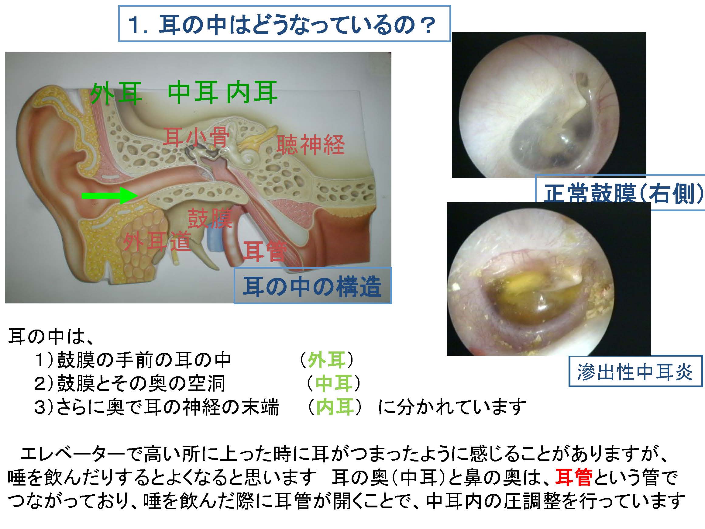 中耳炎 ほっとく と どうなる