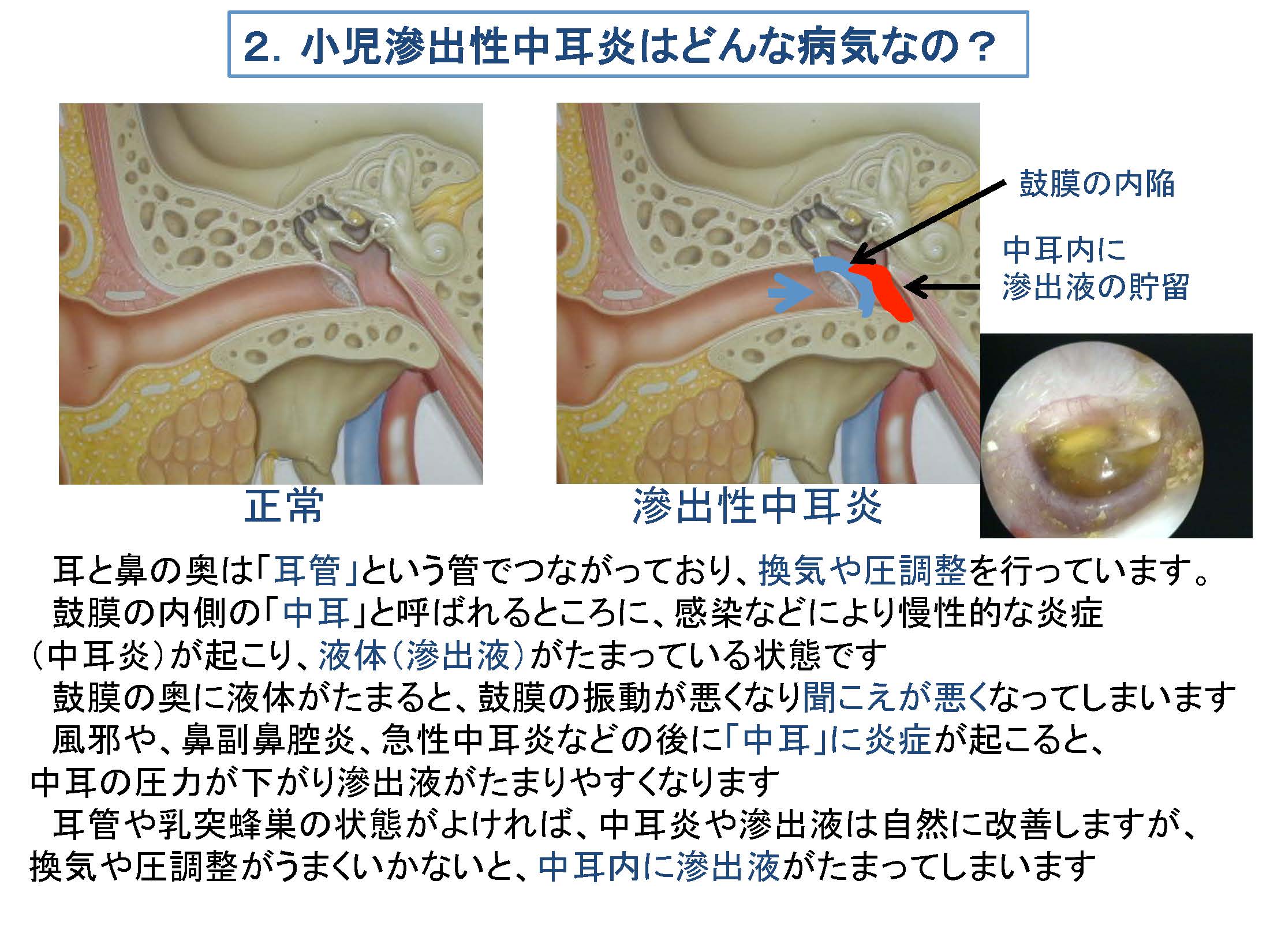 耳 に 水 が 溜まる 中耳炎