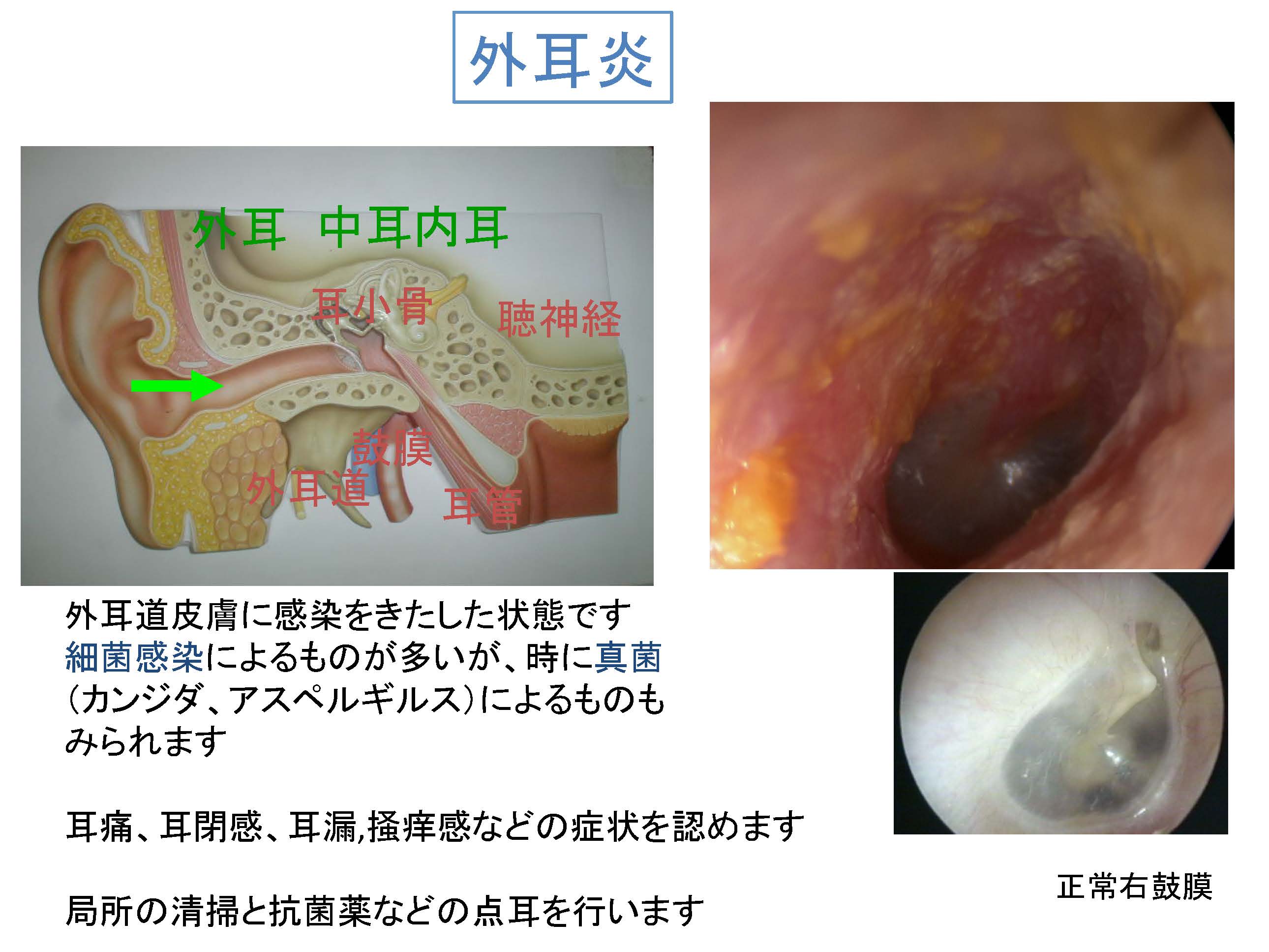 外耳 炎 薬