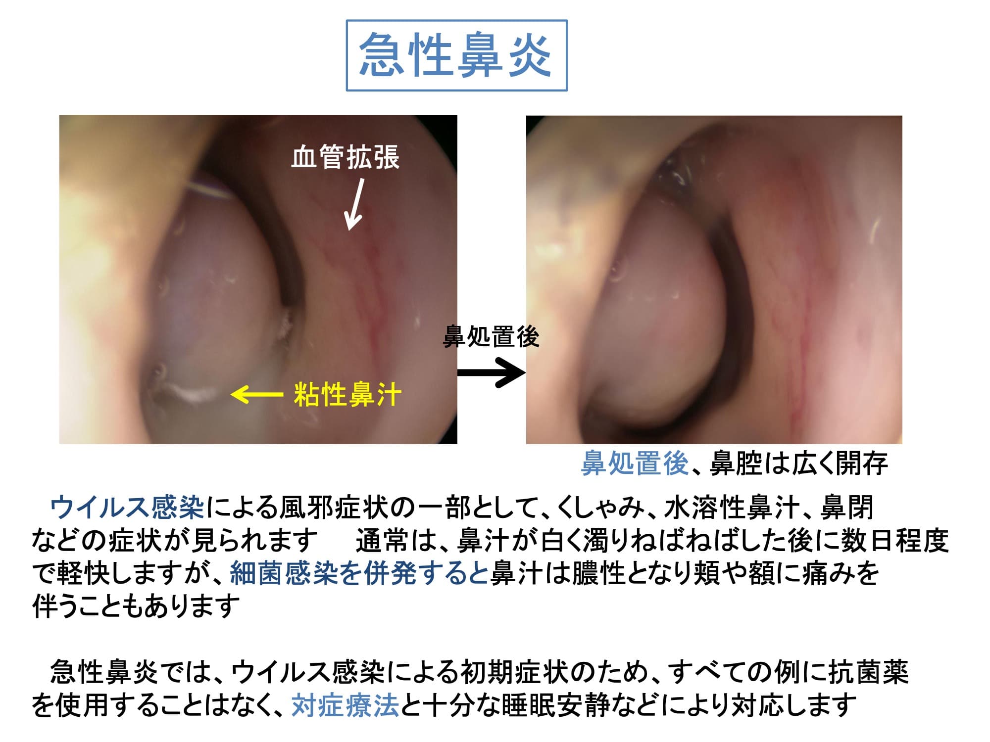 急性鼻炎