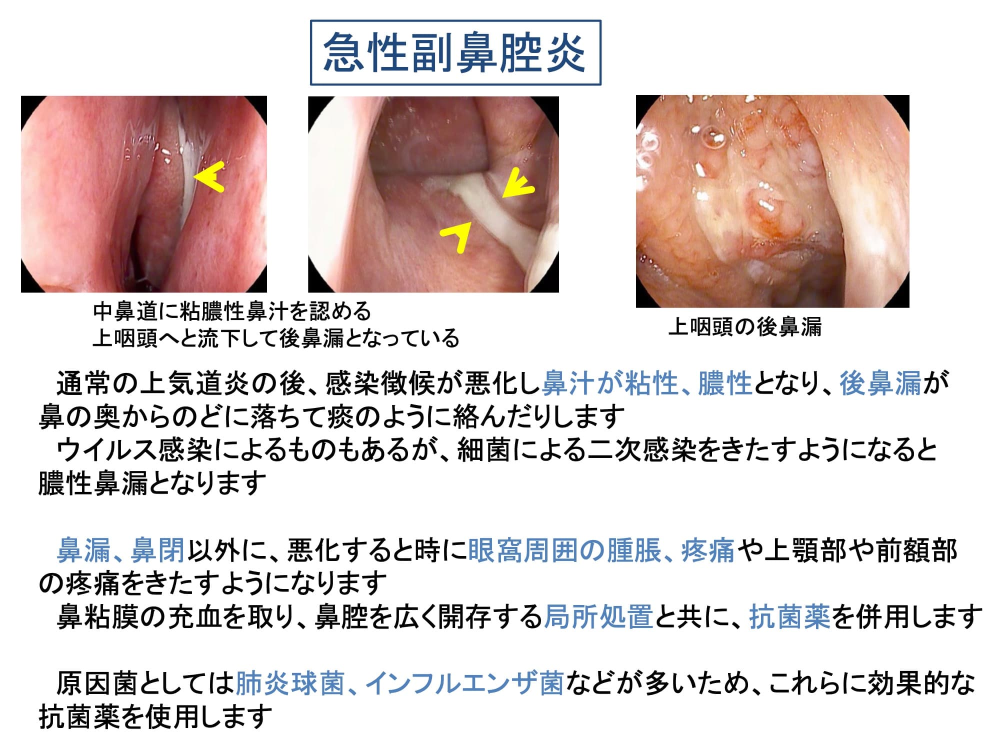 急性副鼻腔炎