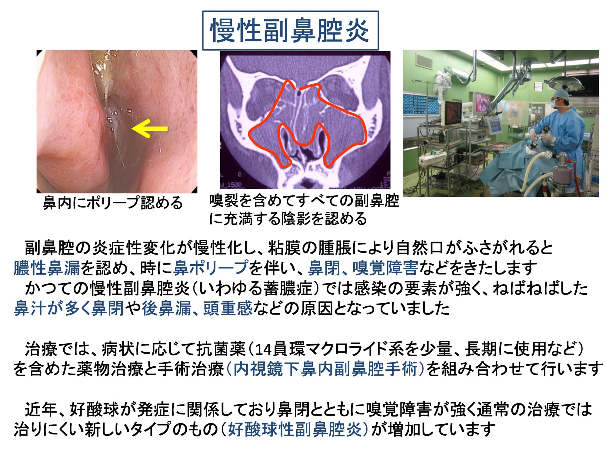 慢性副鼻腔炎