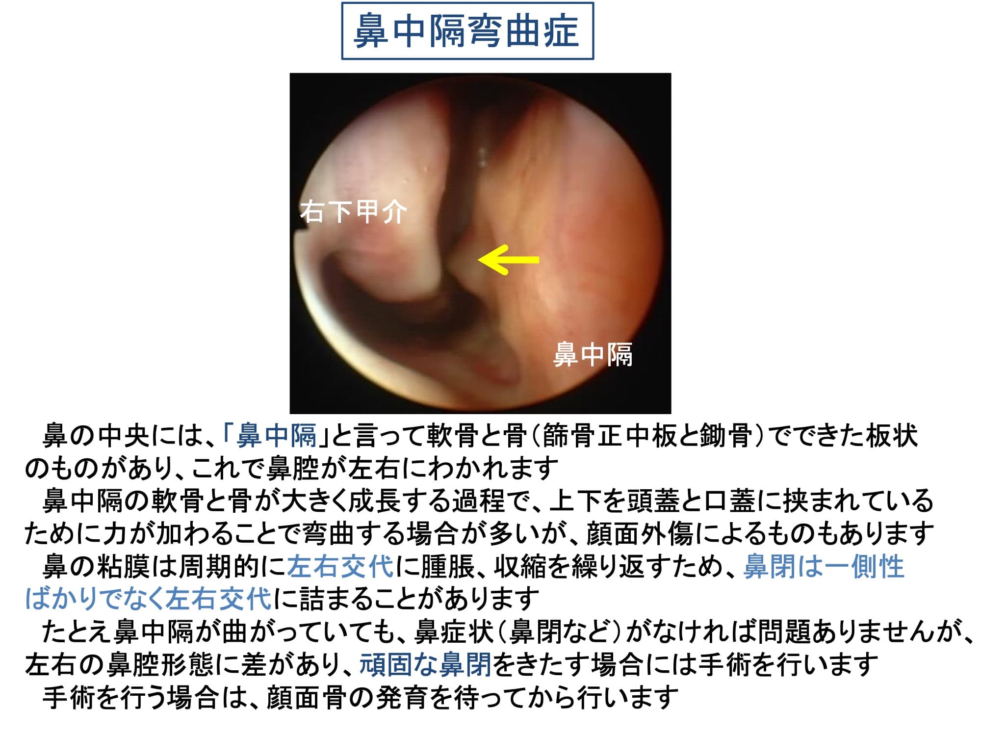 鼻中隔弯曲症