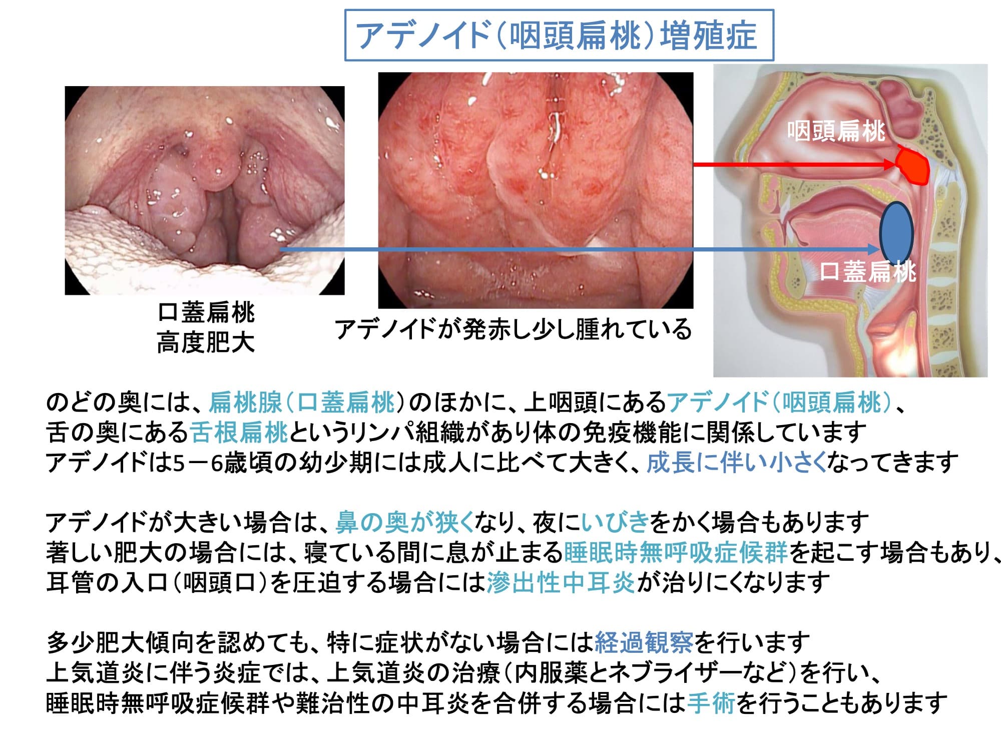 アデノイド（咽頭扁桃）増殖症