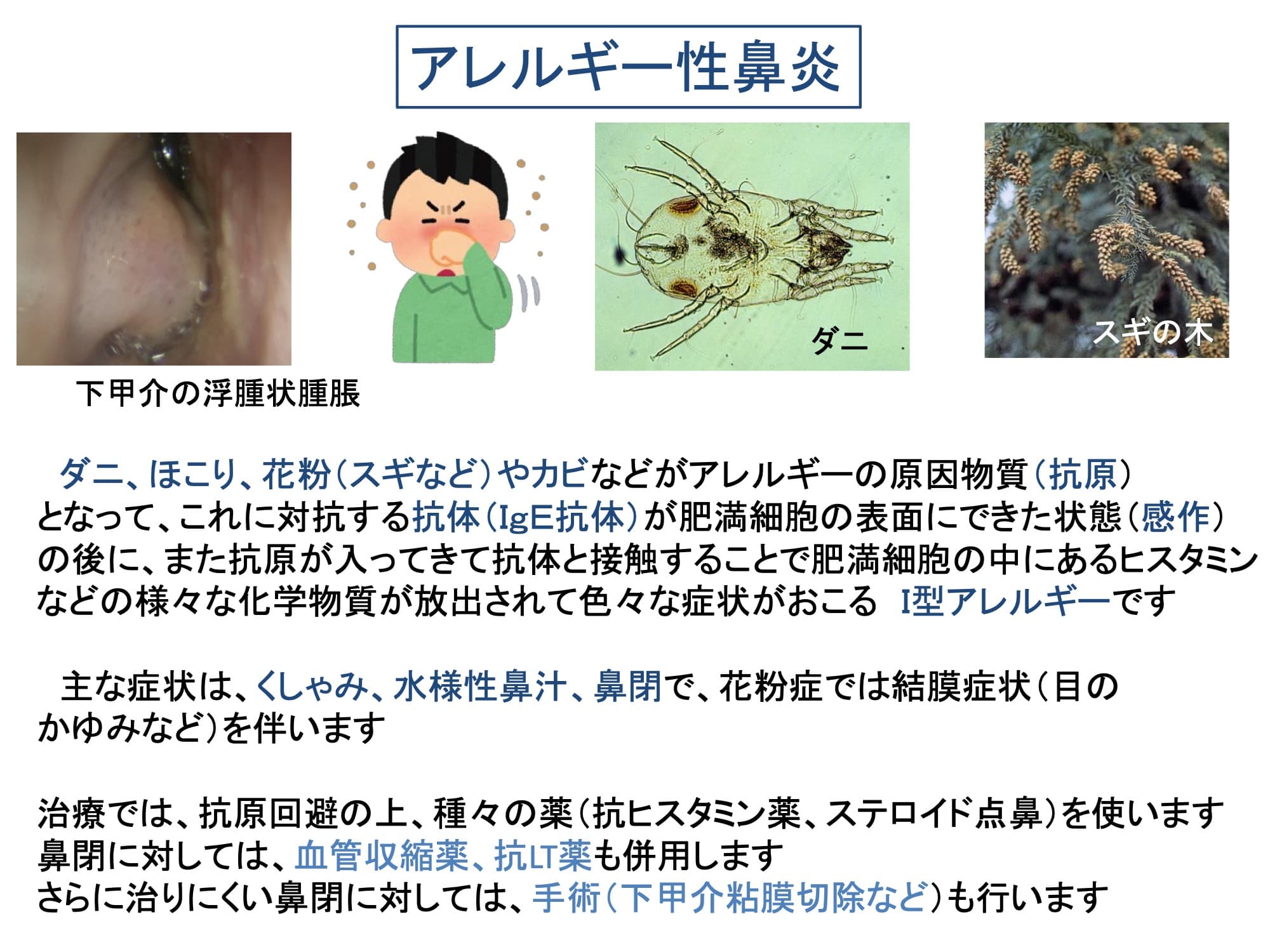 アレルギー性鼻炎