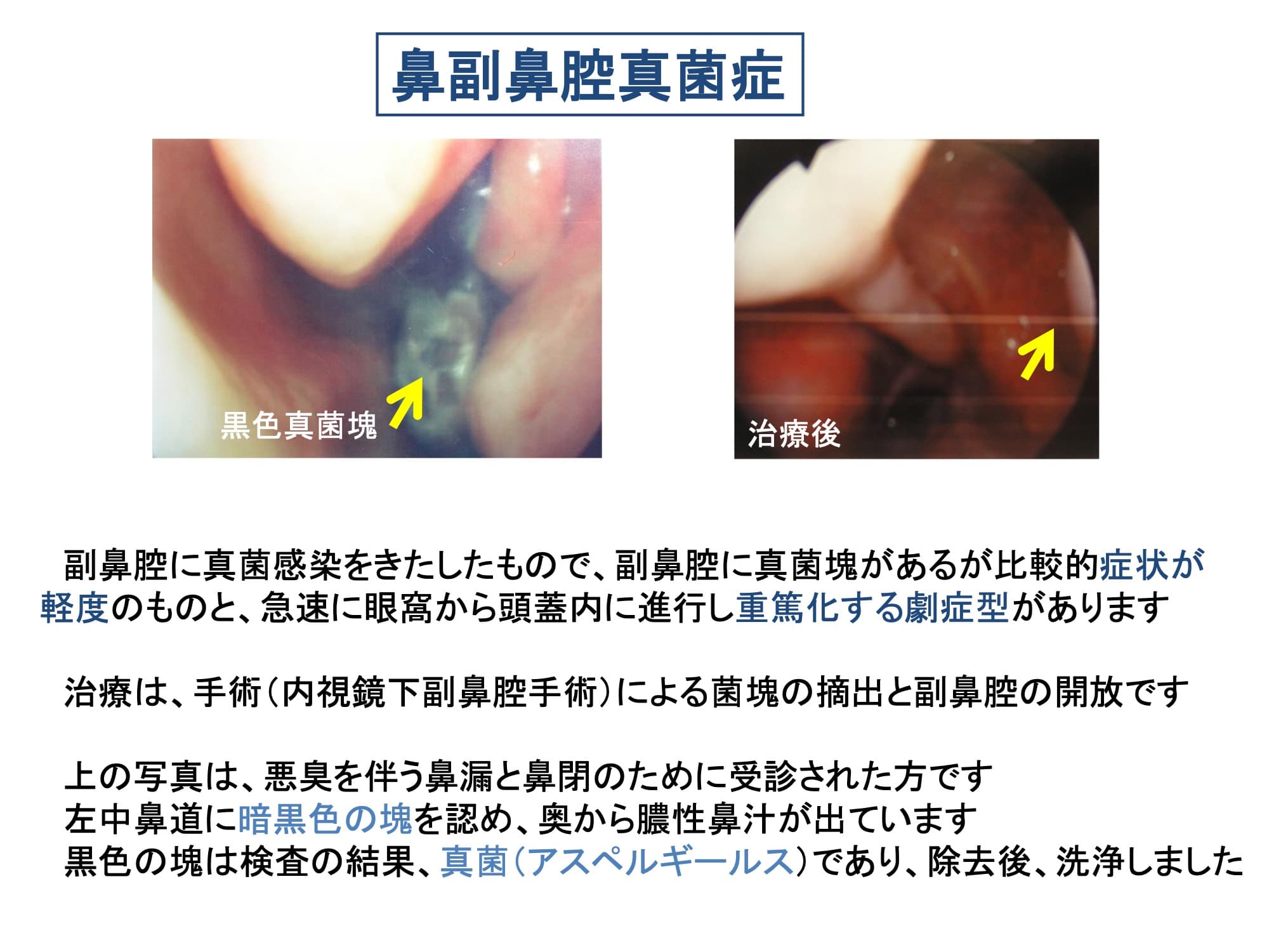 鼻副鼻腔真菌症