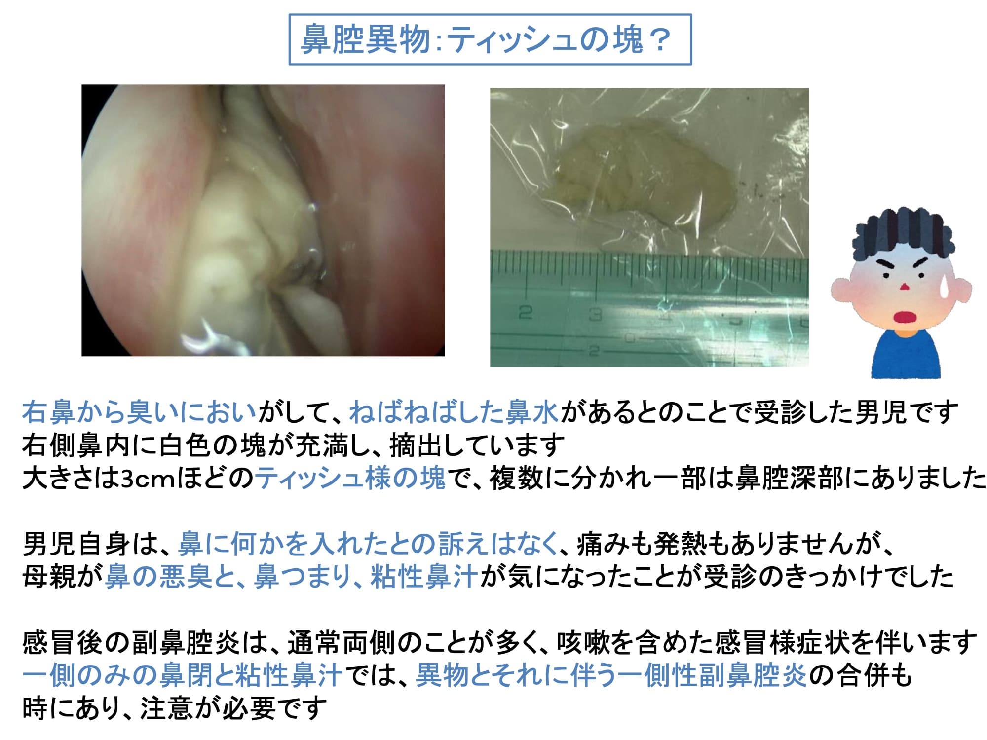 鼻腔異物：ティッシュの塊？