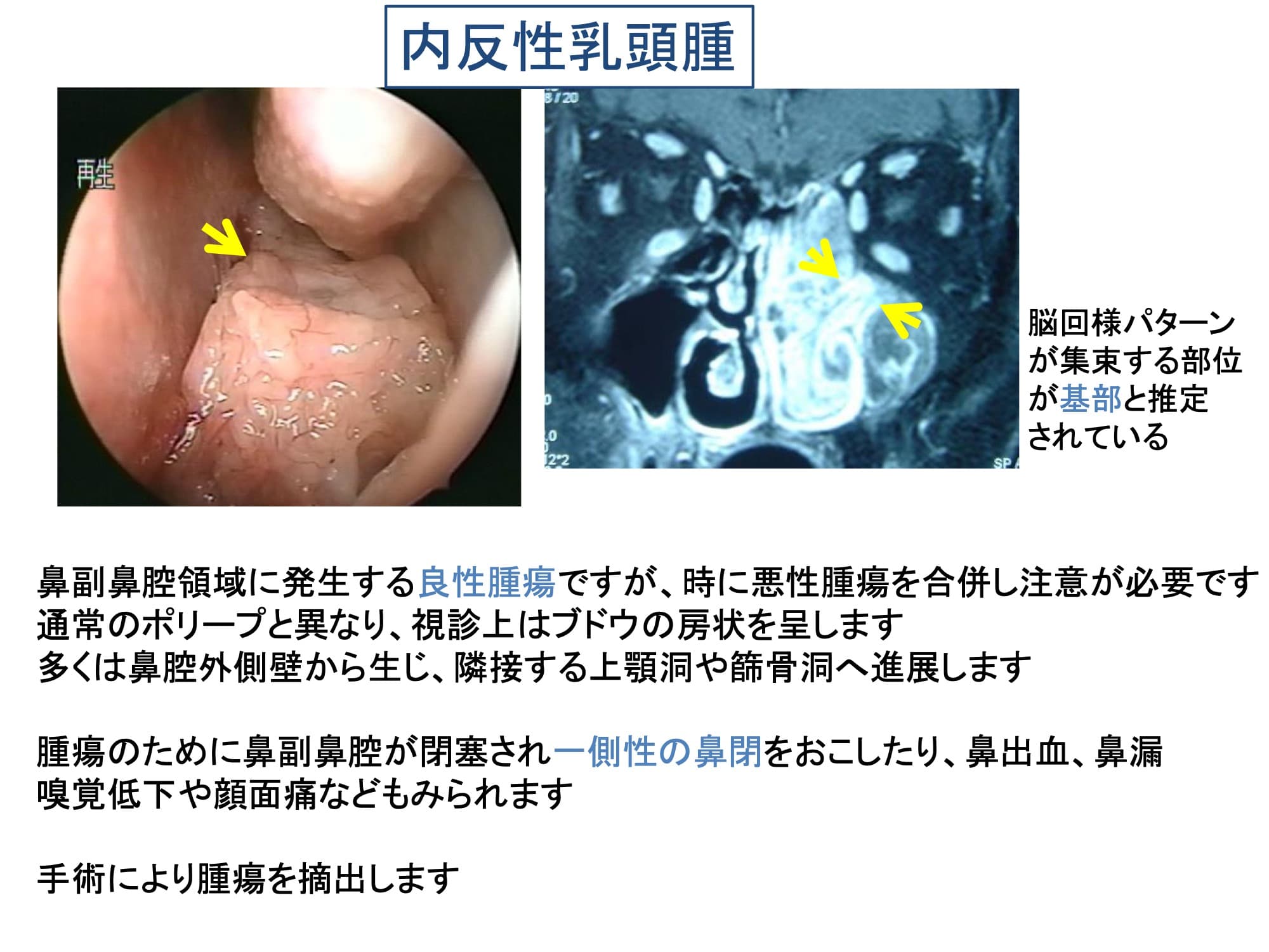 内反性乳頭腫