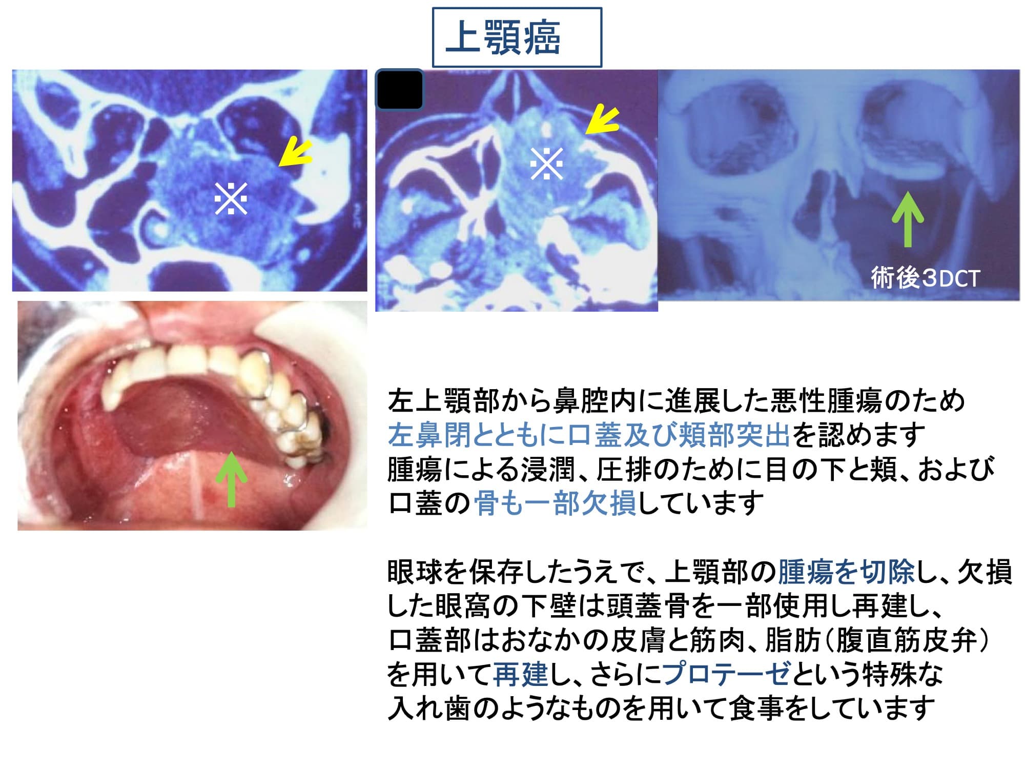 上顎癌
