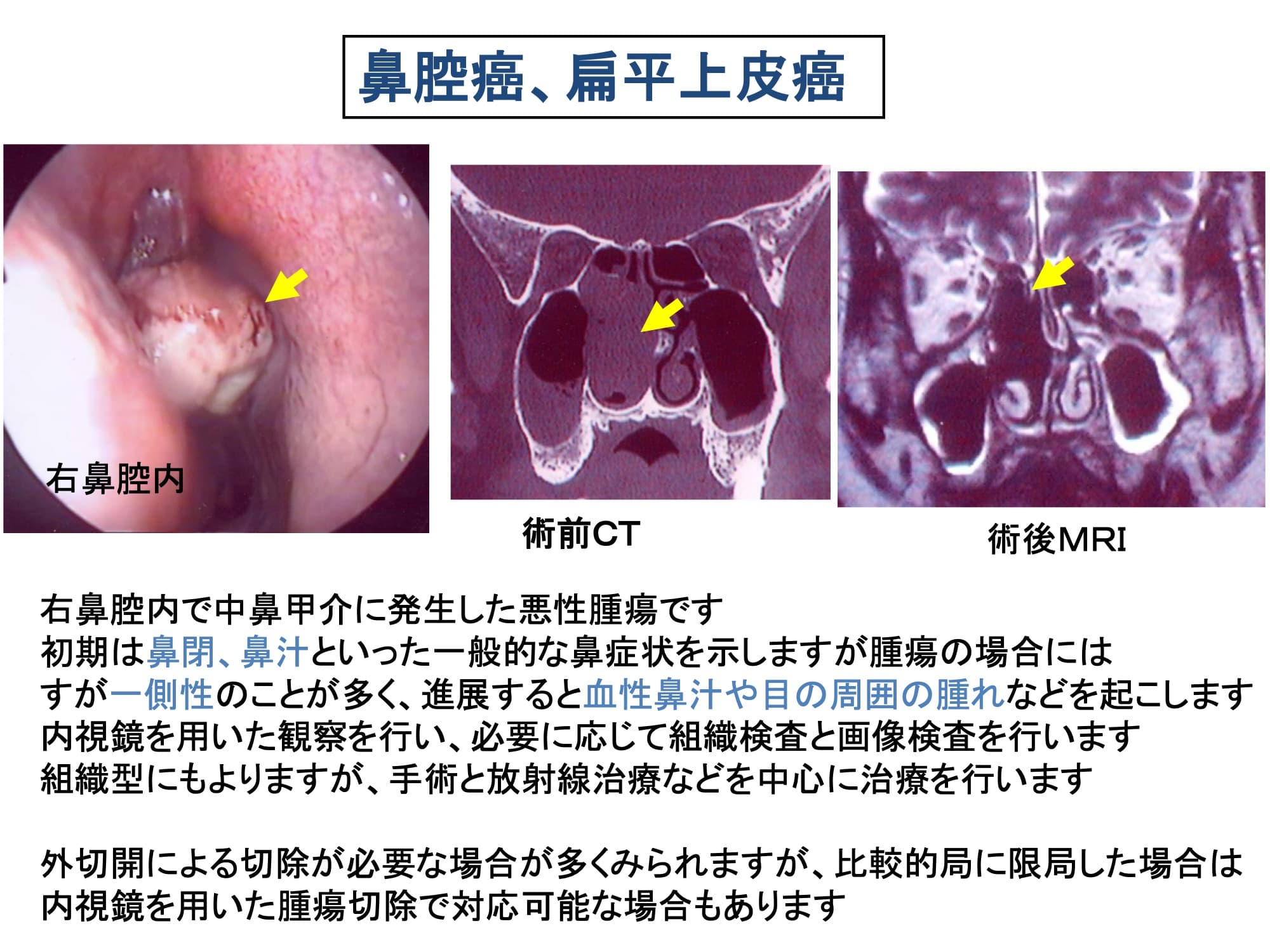 鼻腔癌、扁平上皮癌