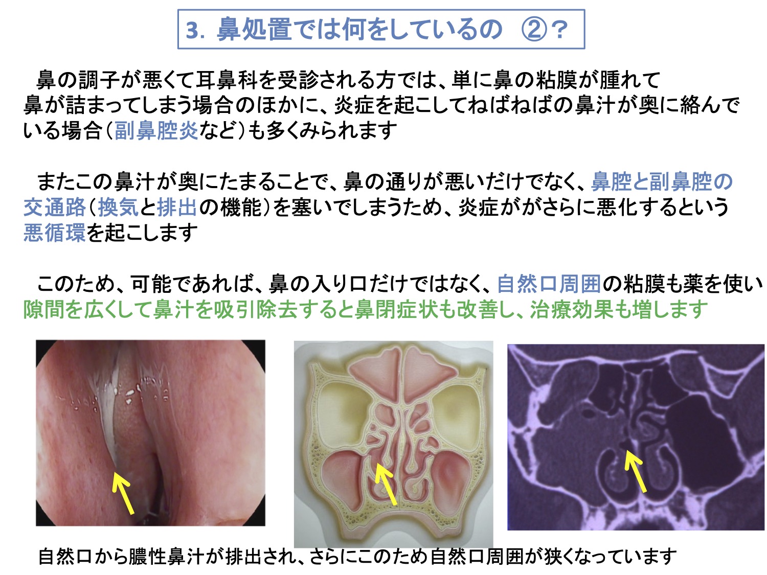 3. 鼻処置では何をしているの②？