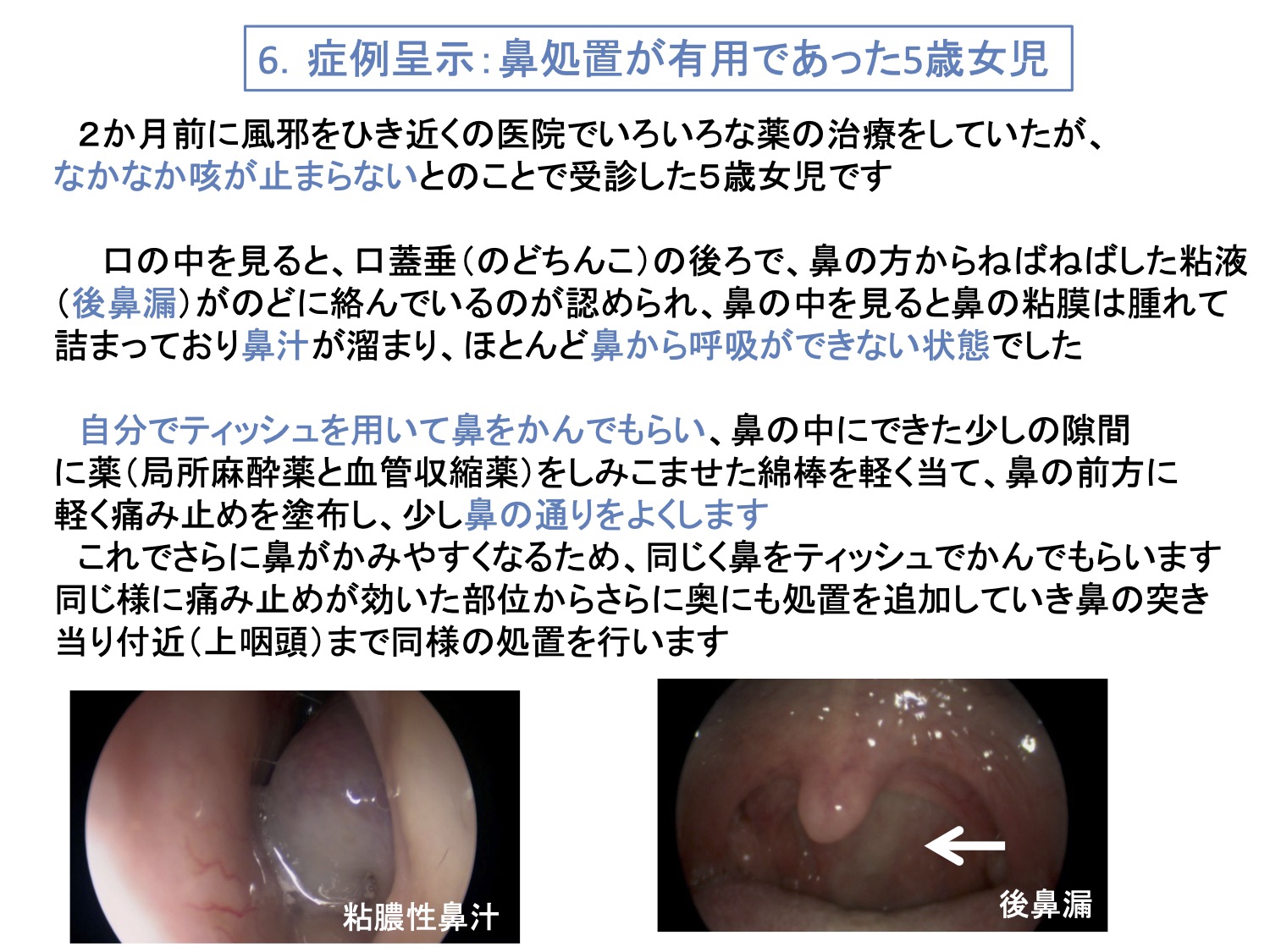 6. 症例呈示：鼻処置が有用であった5歳女児