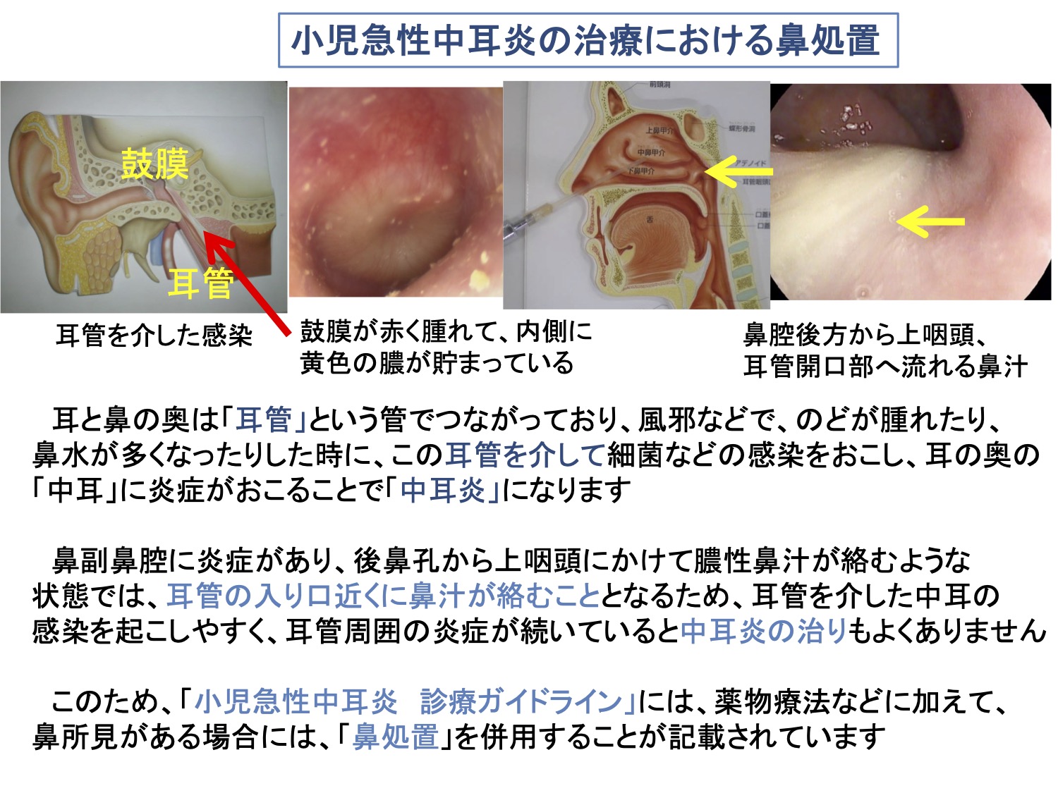 小児急性中耳炎の治療における鼻処置