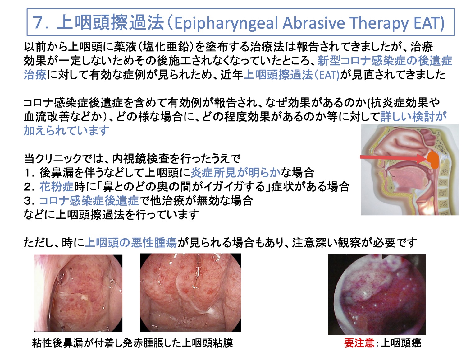 7. 上咽頭擦過法（Epipharyngeal Abrasive Therapy EAT）
