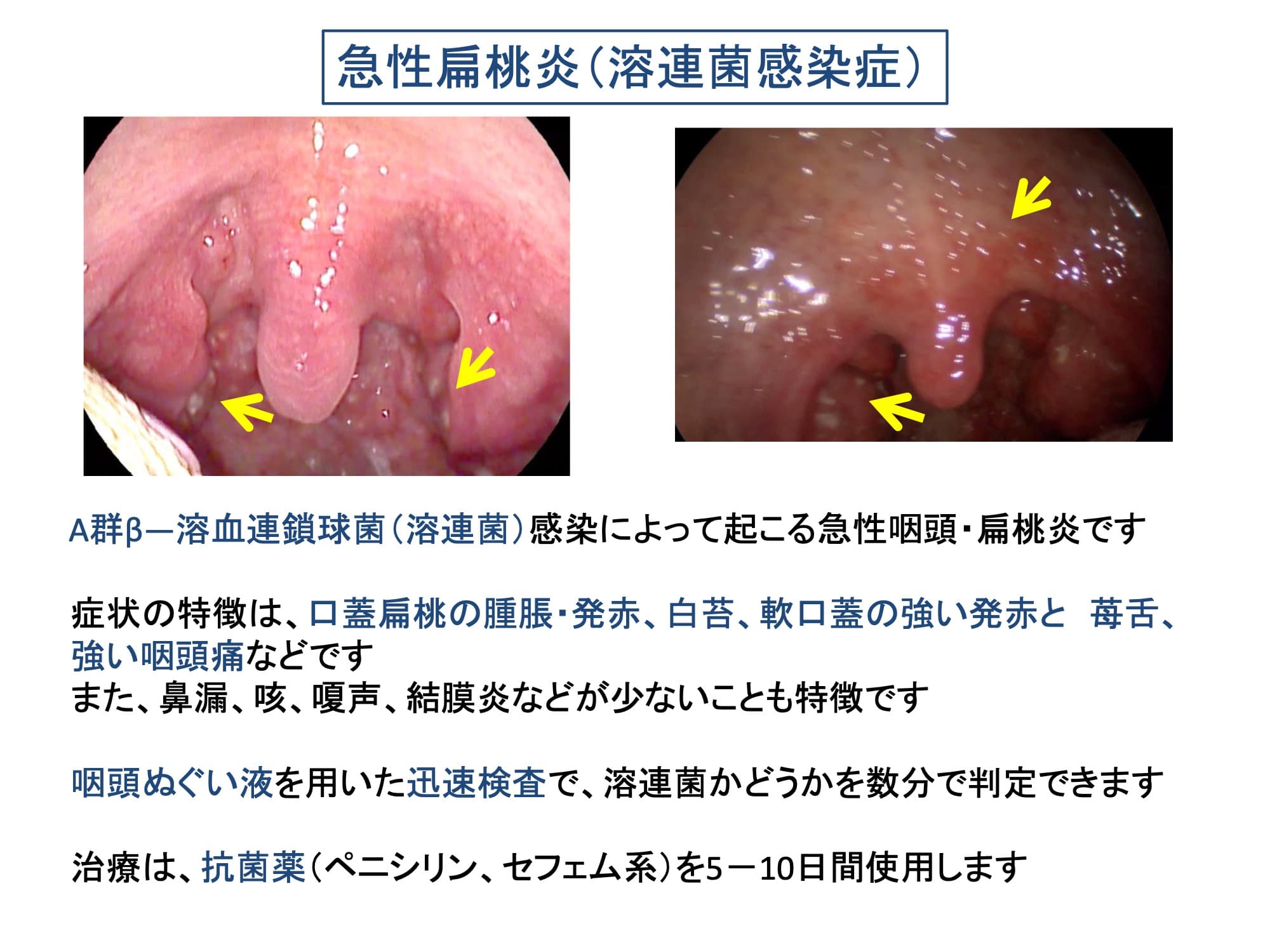 急性扁桃炎（溶連菌感染症）