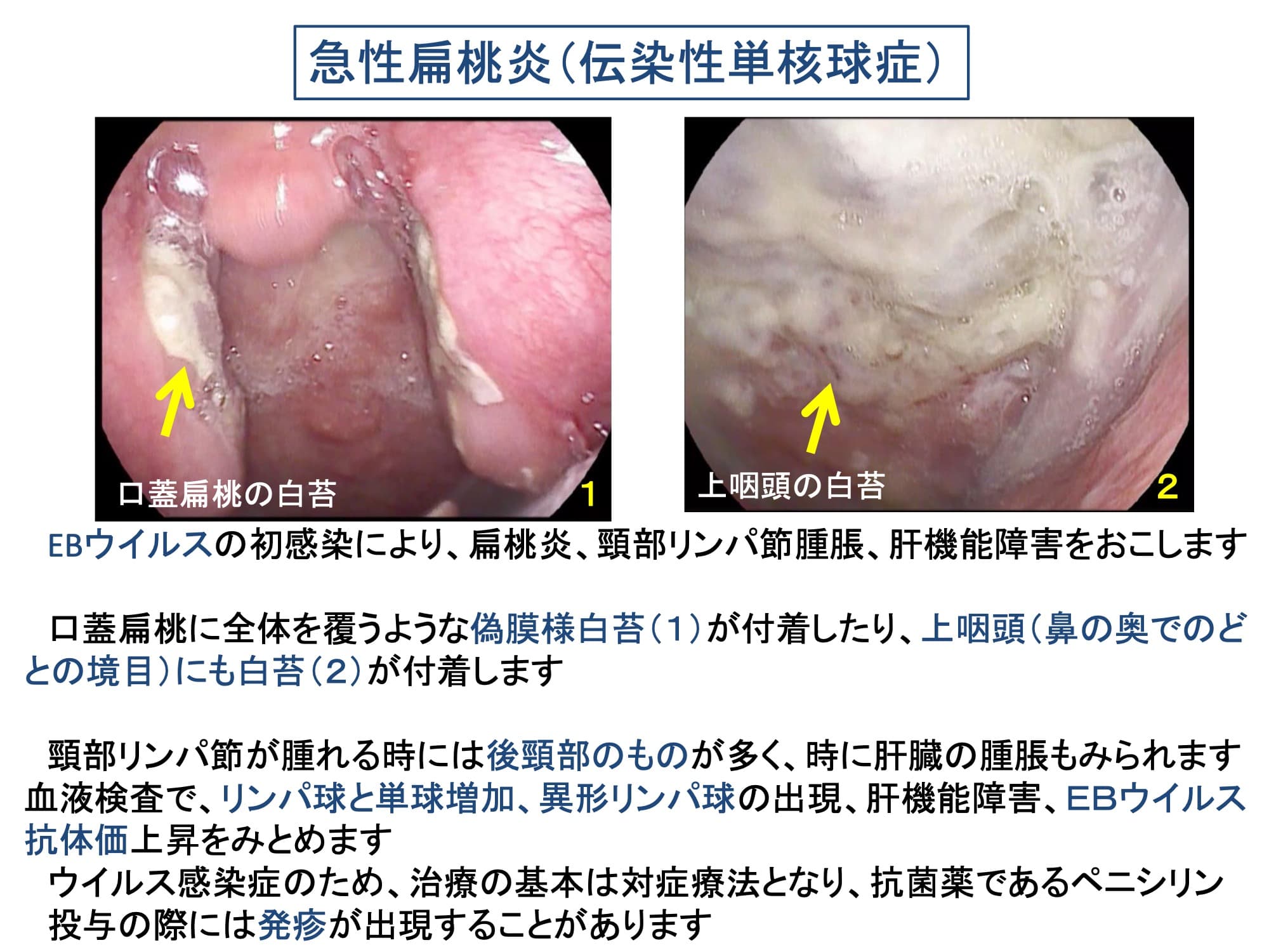 急性扁桃炎（伝染性単核球症）