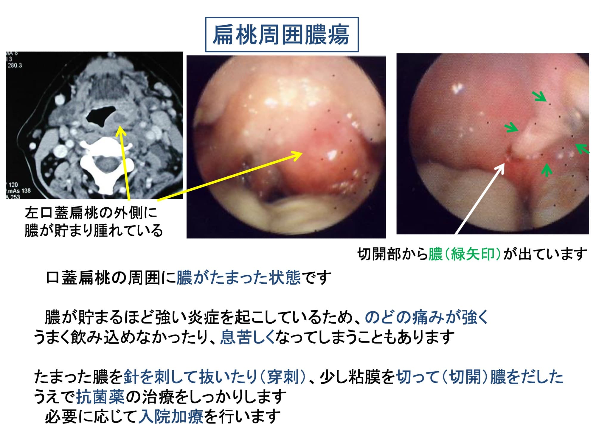 扁桃周囲膿瘍