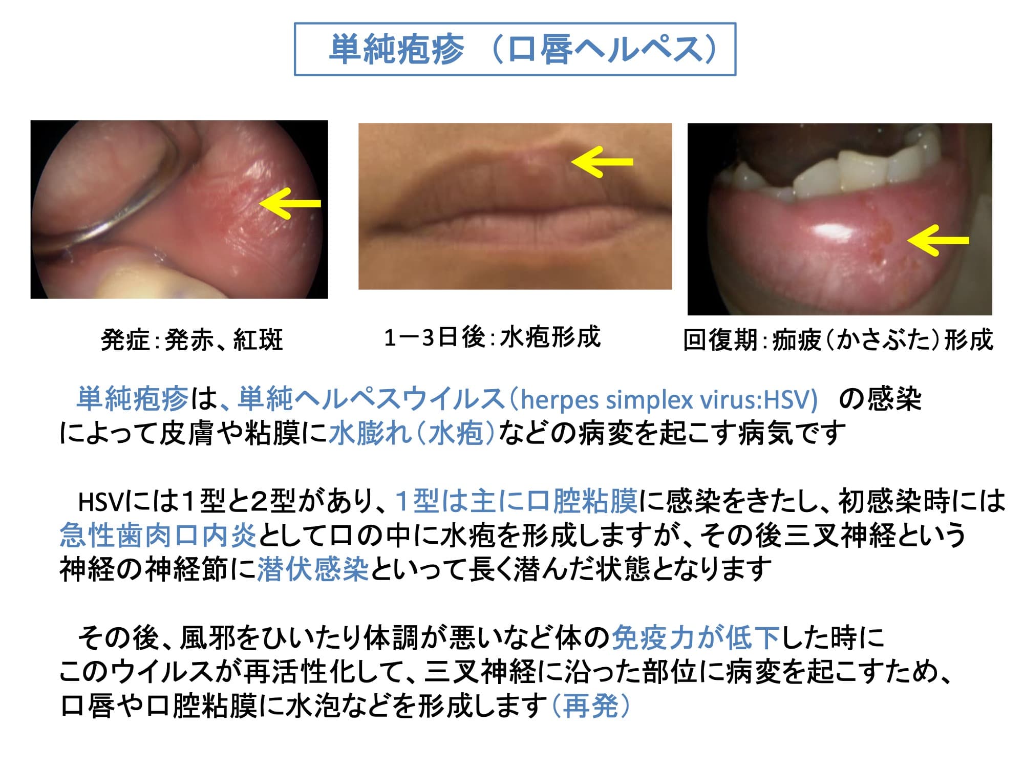 単純疱疹（口唇ヘルペス）