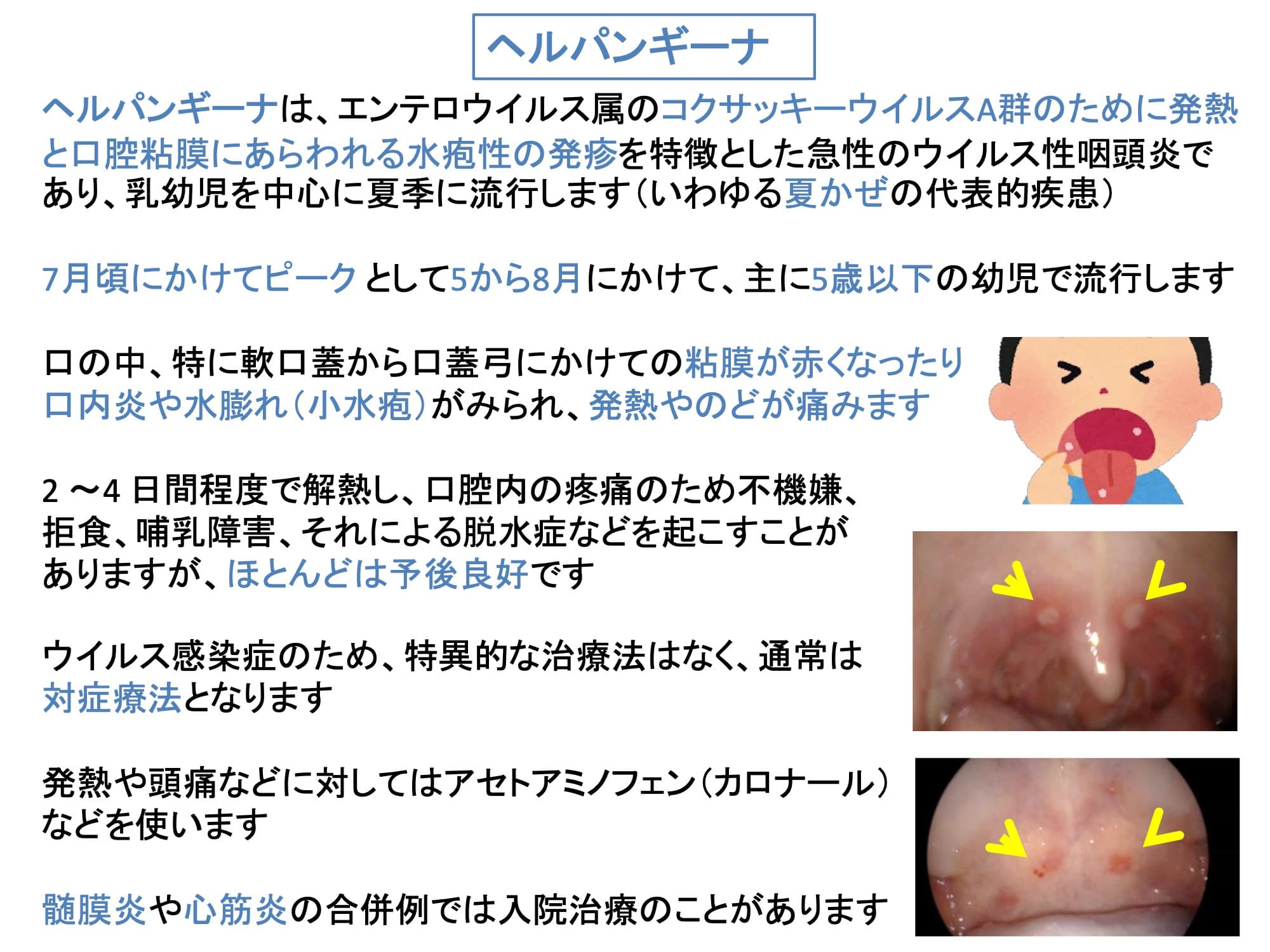 ヘルパンギーナ