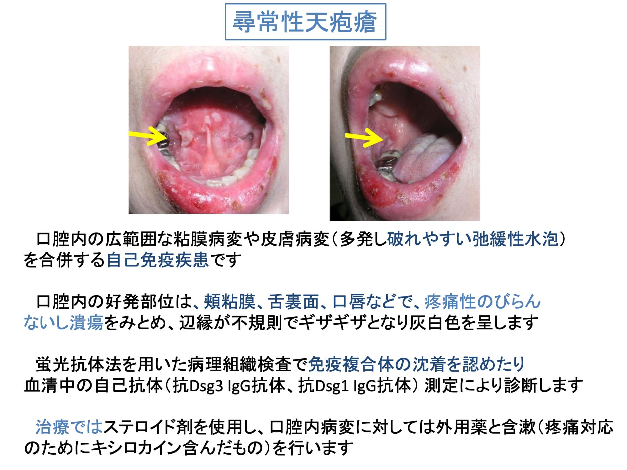 尋常性天疱瘡