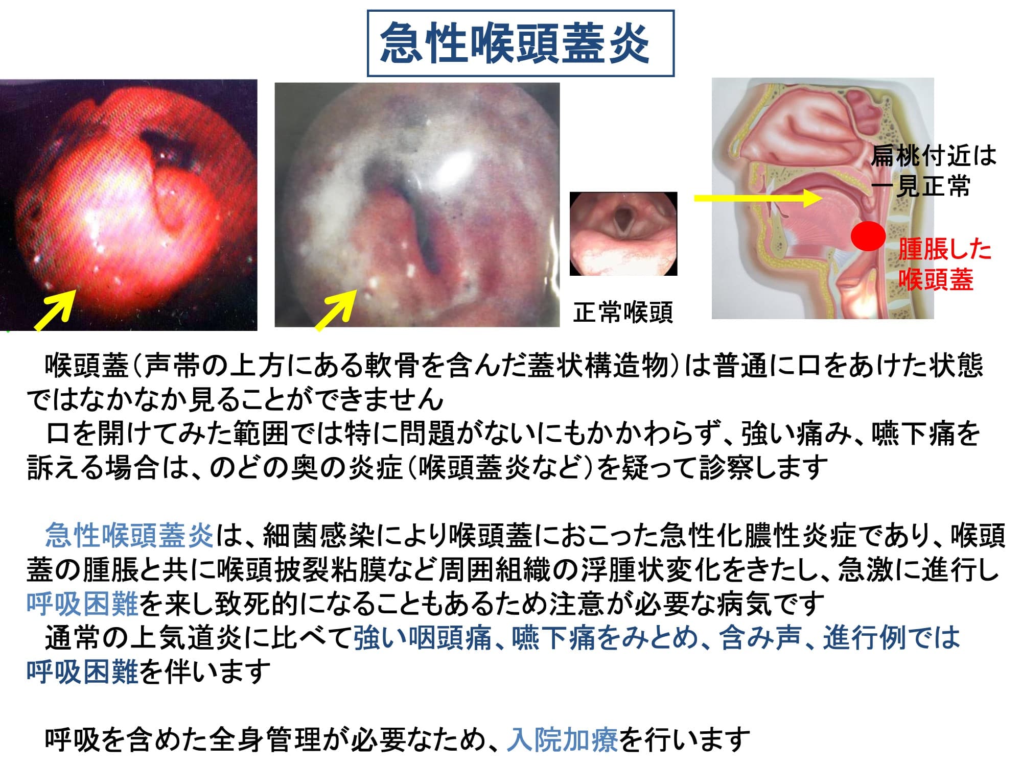 急性喉頭蓋炎