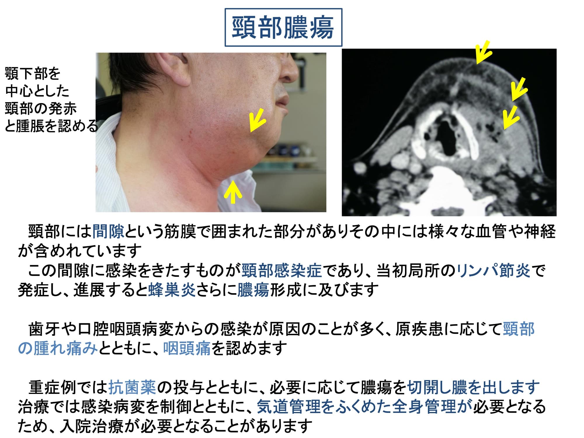 頸部膿瘍