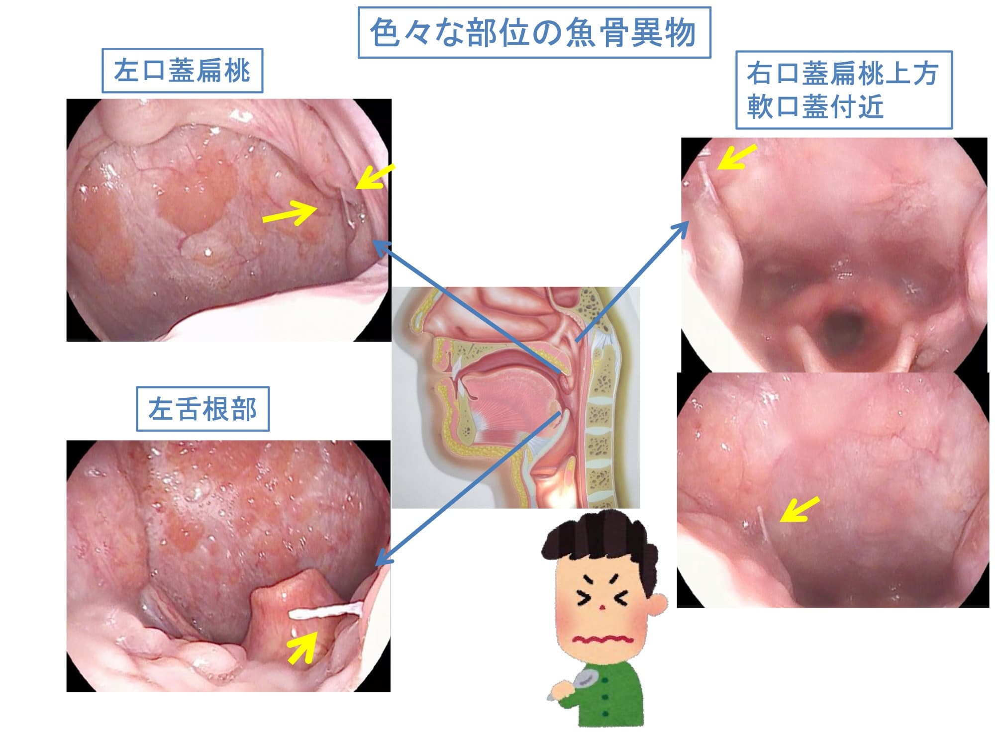 色々な部位の魚骨異物