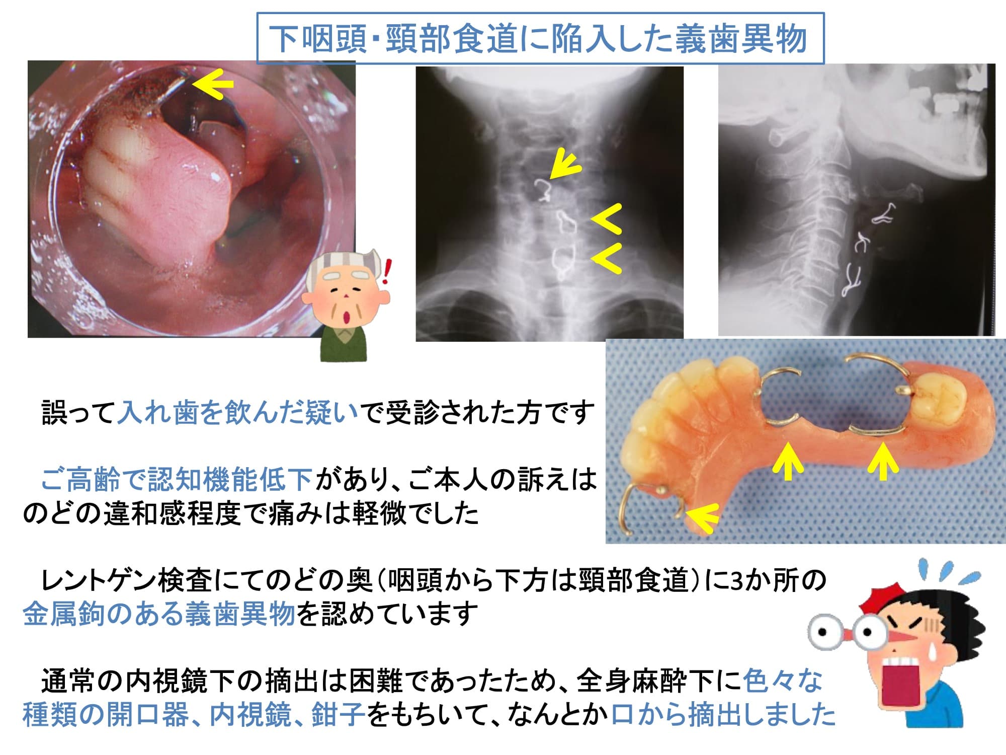 下咽頭・頸部食道に陥入した義歯異物