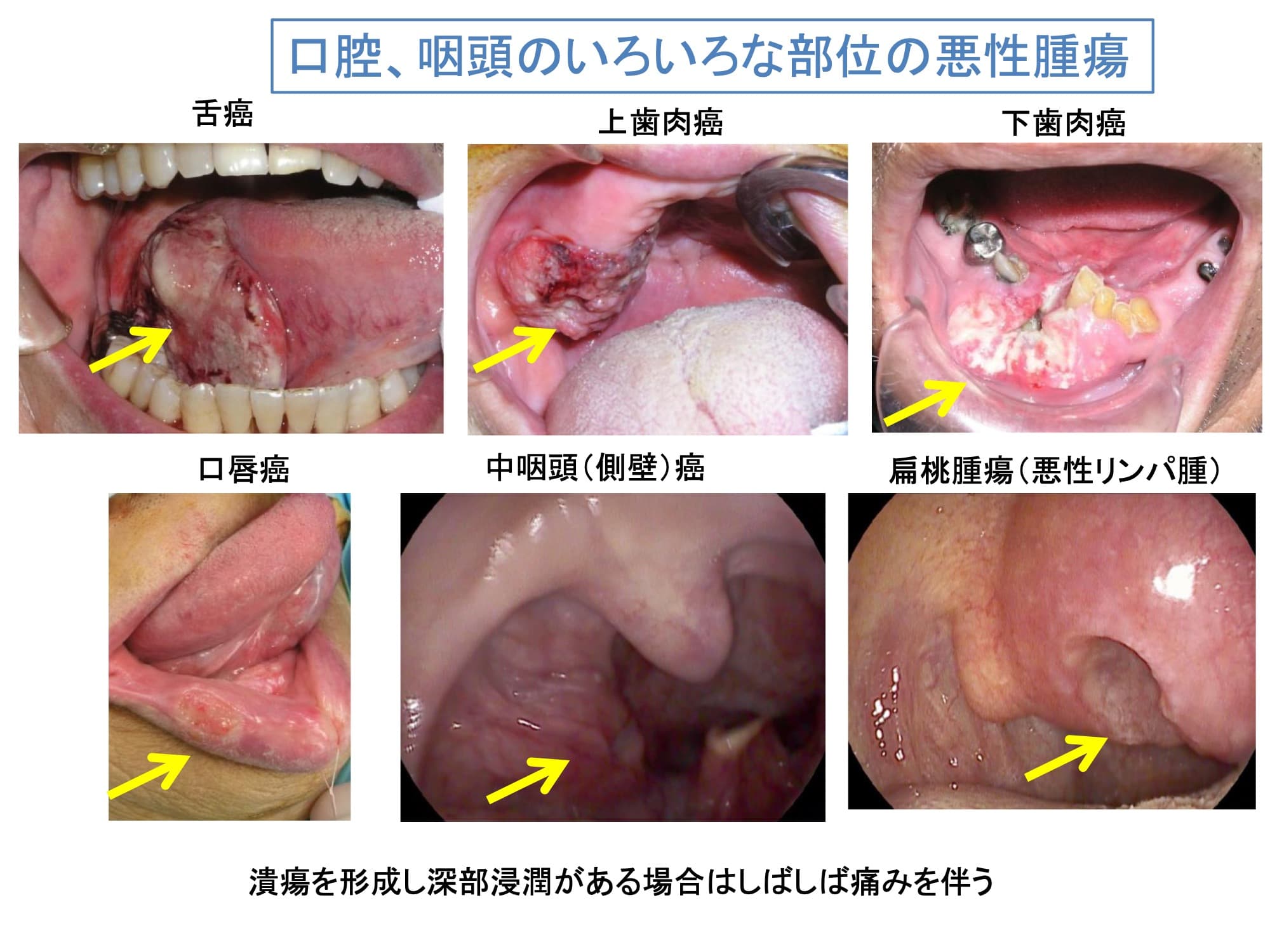 口腔、咽頭のいろいろな部位の悪性腫瘍