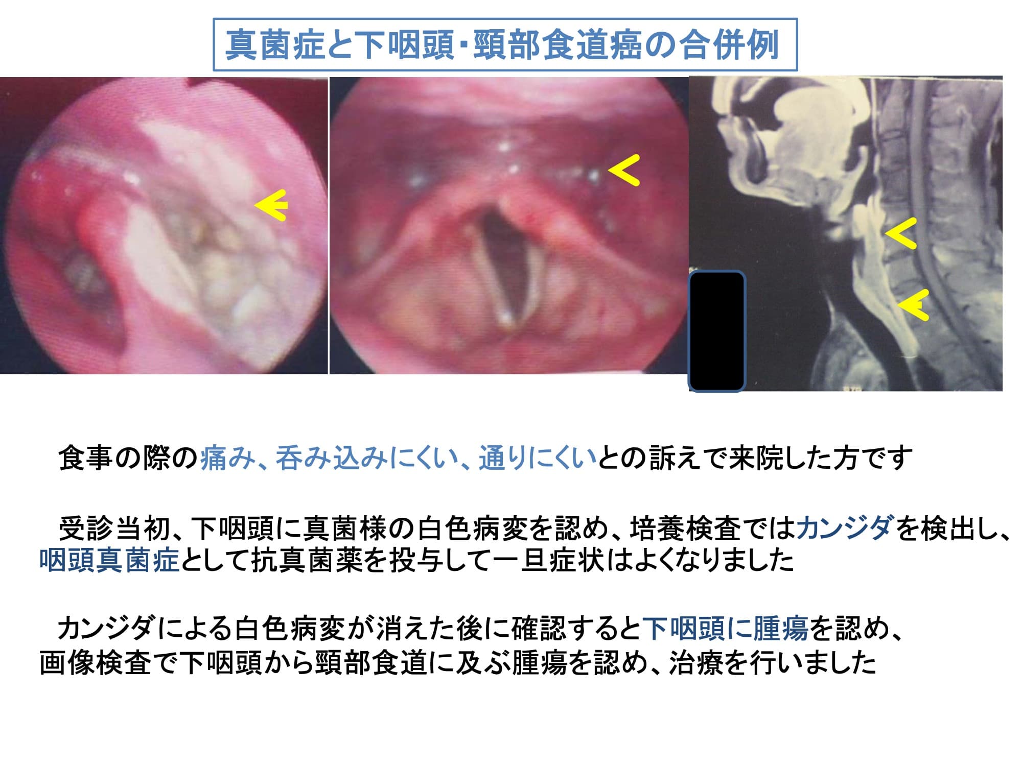 真菌症と下咽頭・頸部食道癌の合併例
