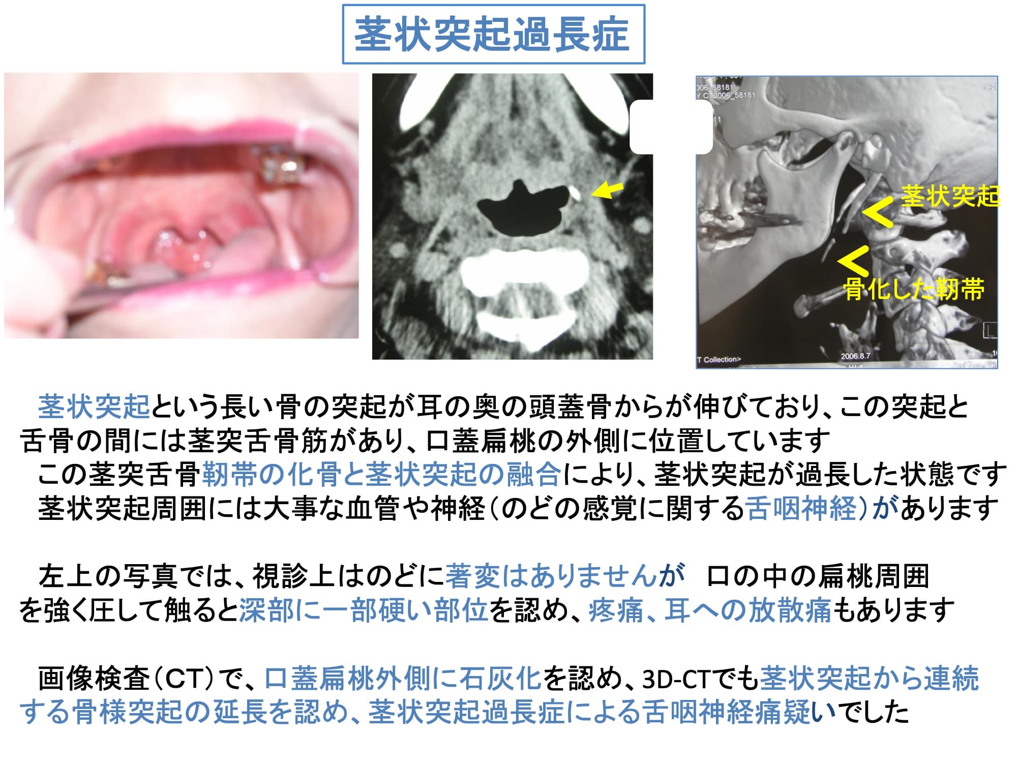 茎状突起過長症